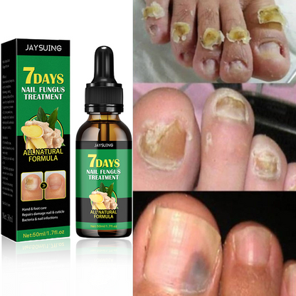 👋🦠Anti Hongos Uñas - 7 Days™  2UND 30ml
