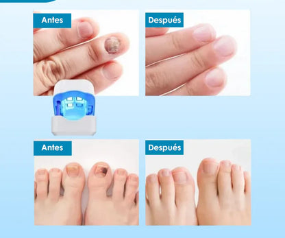 🛸Dispositivo laser LED  - Anti Hongos Uñas 👋🦠