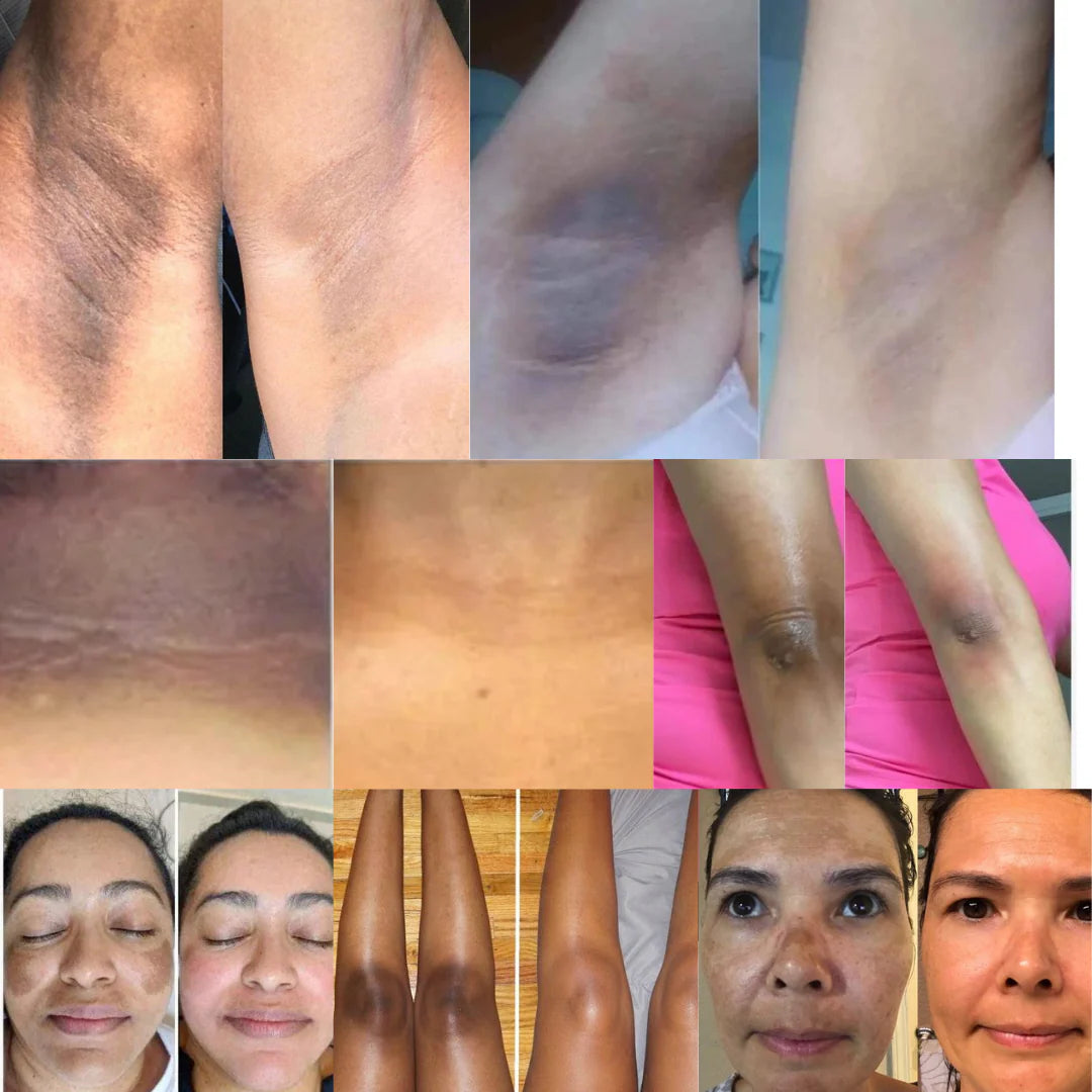 🤍PROMO- 2Unds Crema Blanqueadora Nigrifree® Aclarante Piel y Más!! 🤍