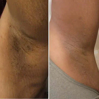 Almohadillas de cúrcuma y ácido kójico - piel radiante en menos de 2 semanas
