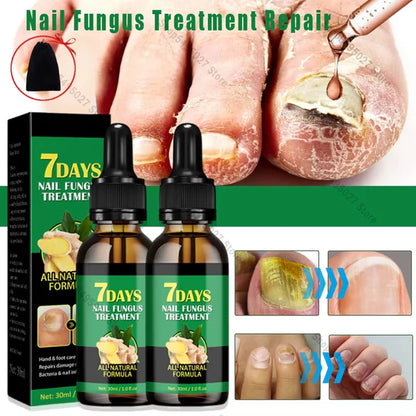 👋🦠Anti Hongos Uñas - 7 Days™  2UND 30ml